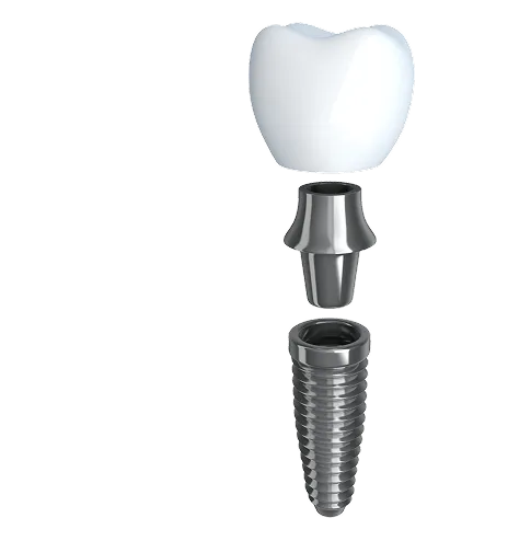 DENTAL IMPLANTS