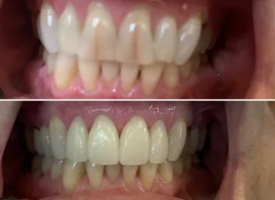 Crown 4 Front Teeth before and after