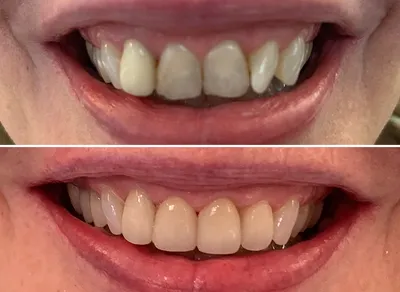Crown Front Teeth before and after