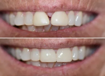 Crown 2 Front Teeth before and after