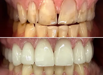 Crown Upper Teeth before and after