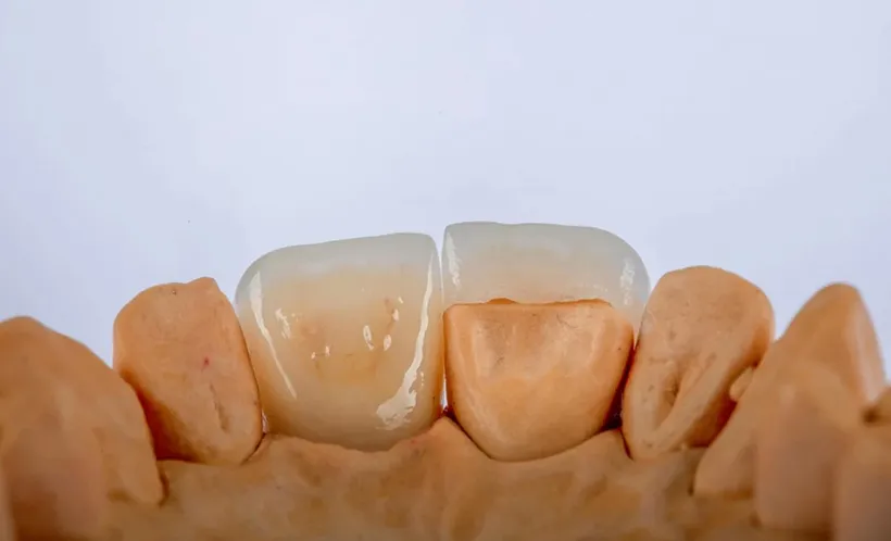 Dental Crown