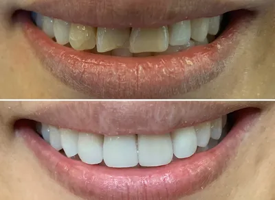 Dental Crowns before and after