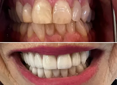 Dental Crowns before and after