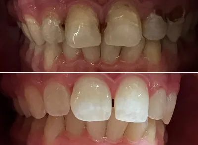 Dental Fillings before and after