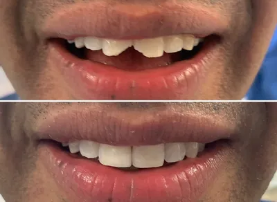 Dental Fillings before and after