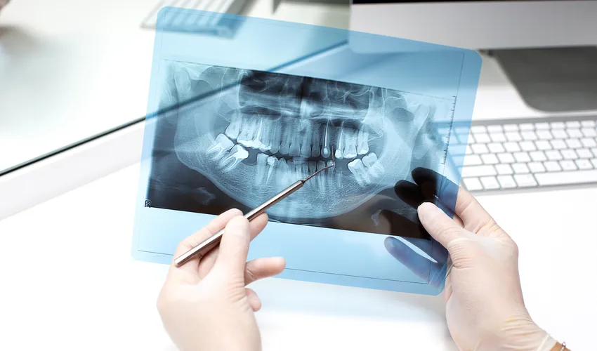 Dental X-Rays