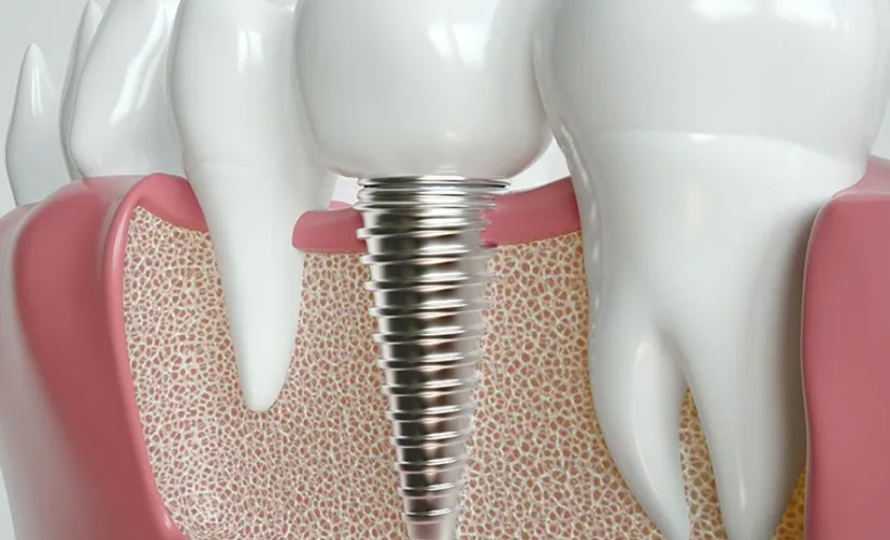 Dental Implants