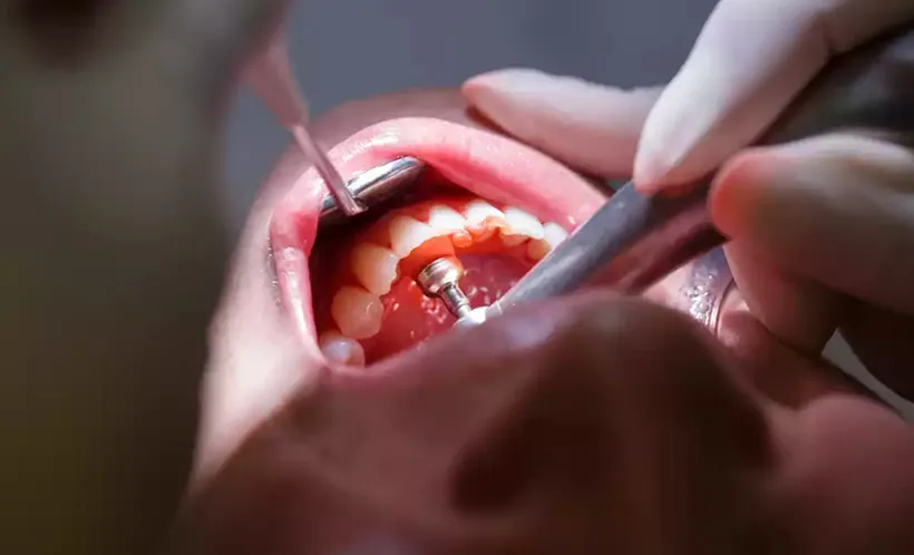 Prophylaxis & Periodontal Cleaning